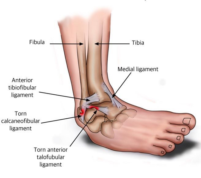 ankle sprain