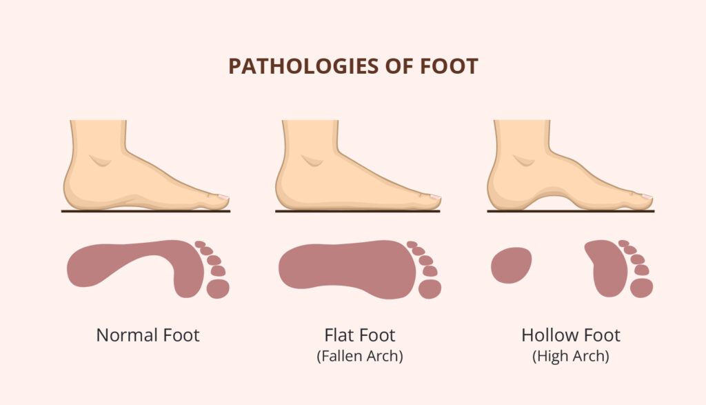 Flat foot